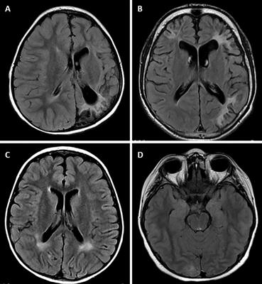 Neurological Characteristics of Pediatric Glycogen Storage Disease